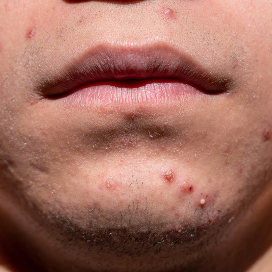 Acné en hombres: causas y cuidado de la piel del rostro y la espalda