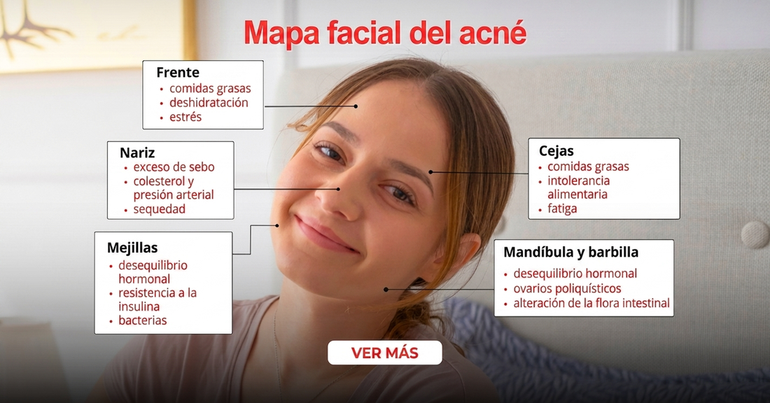 Mapa facial del acné por zonas del rostro
