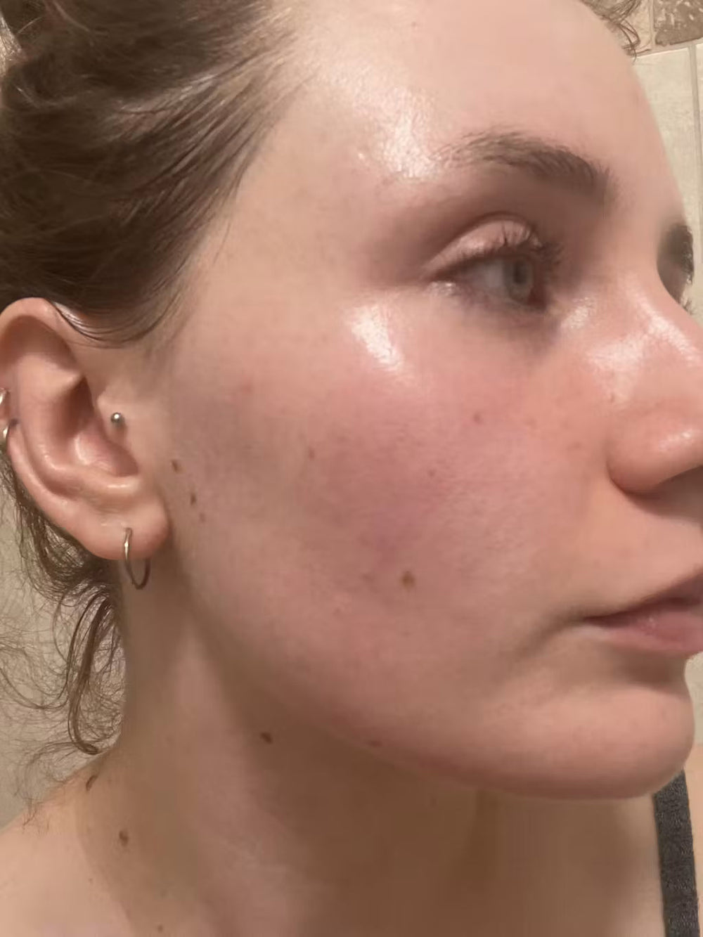 acne ES keep