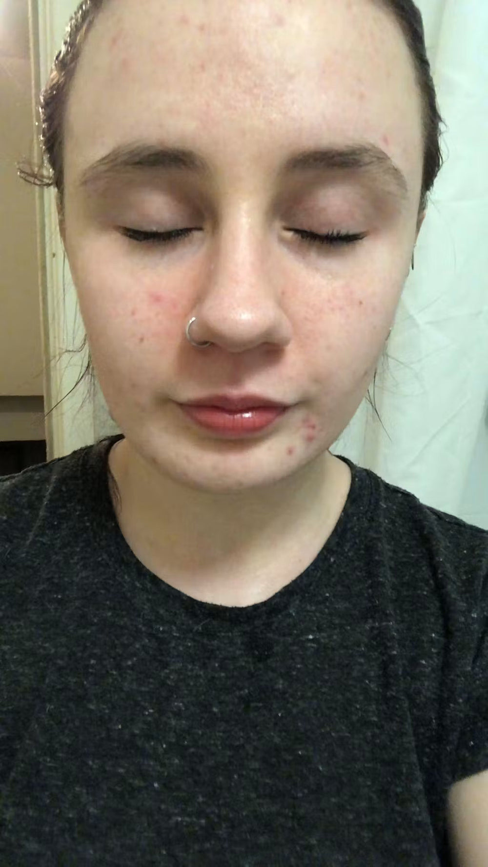 acne ES keep