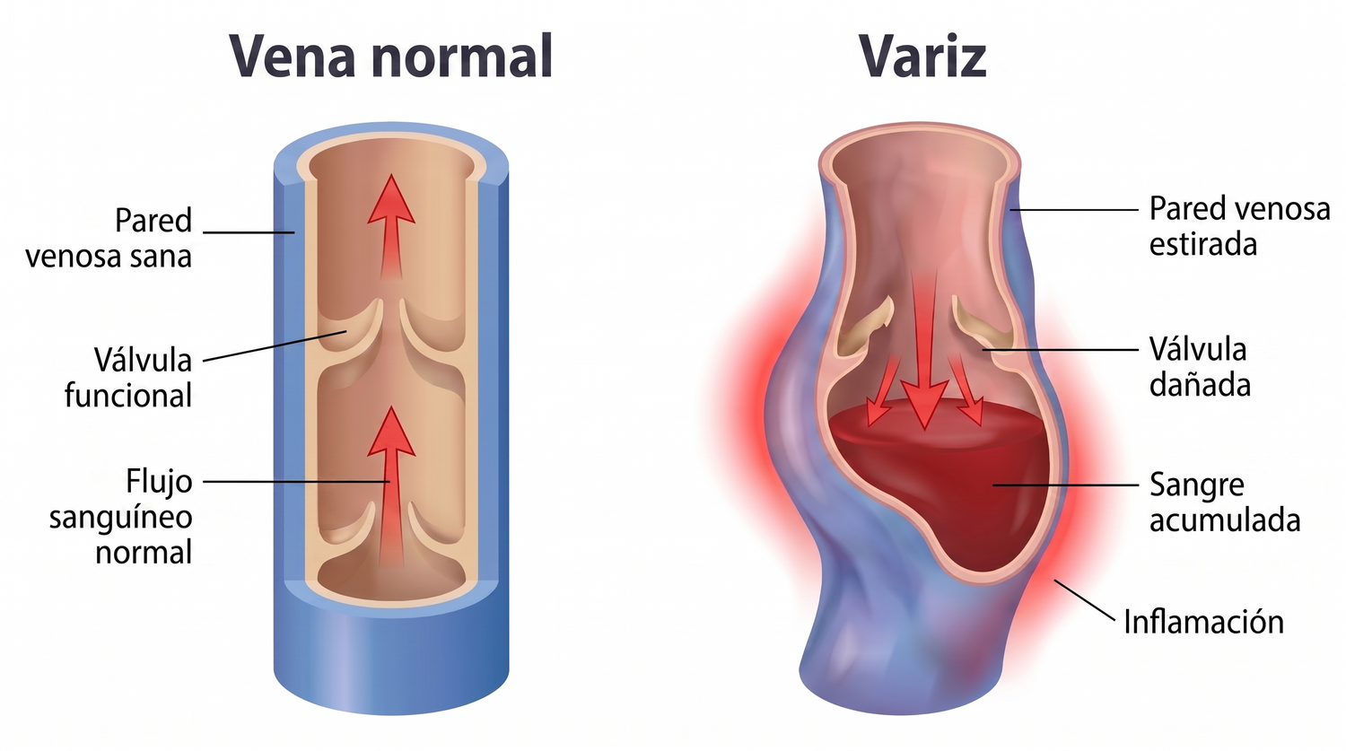 periodontis